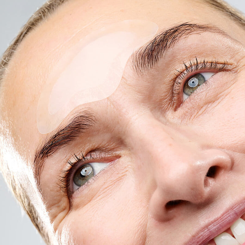 RF Microneedling Treatment